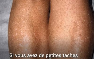 Pourquoi des taches blanches apparaissent-elles sur ma peau en été, et comment puis-je les traiter ? Un dermatologue nous apporte la réponse.