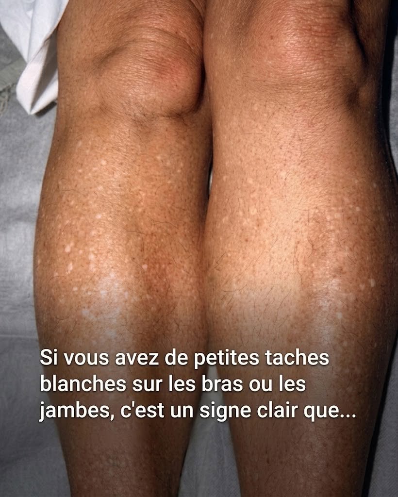 Pourquoi des taches blanches apparaissent-elles sur ma peau en été, et comment puis-je les traiter ? Un dermatologue nous apporte la réponse.